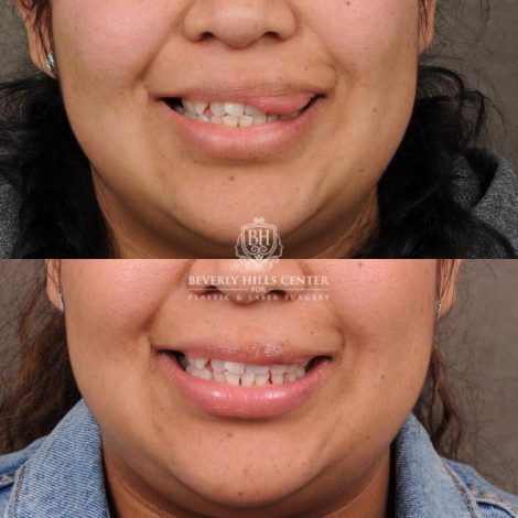 Beverly Hills Center Female Patient Before and After Lip Hemangioma Removal