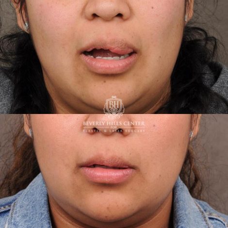 Beverly Hills Center Female Patient Before and After Lip Hemangioma Removal