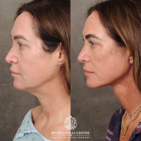 Beverly Hills Center Female Patient Before and After AuraLyft