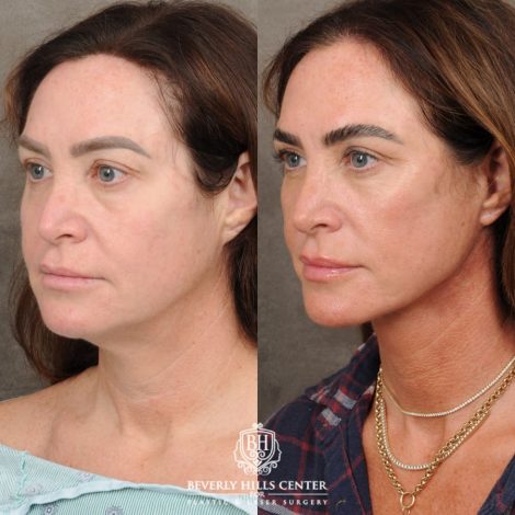 Beverly Hills Center Female Patient Before and After AuraLyft