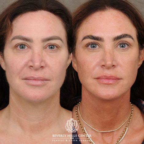 Beverly Hills Center Female Patient Before and After AuraLyft