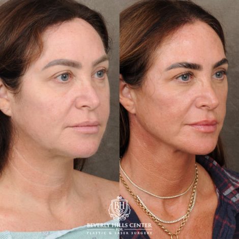 Beverly Hills Center Female Patient Before and After AuraLyft