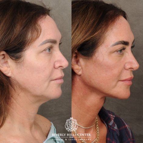 Side-by-side profile photos of a woman before and after a cosmetic procedure, showing smoother skin and a more defined jawline in the after image. Both images have a logo reading Beverly Hills Center at the bottom.