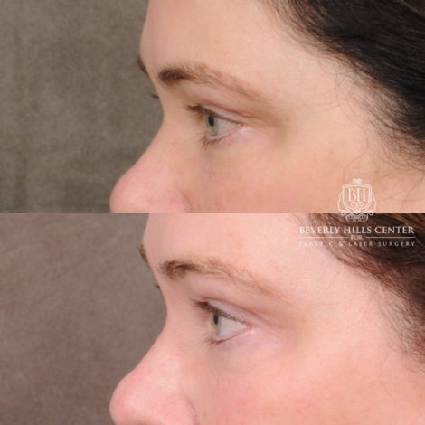 Beverly Hills Center Female Patient Before and After Upper Blepharoplasty