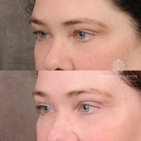 Beverly Hills Center Female Patient Before and After Upper Blepharoplasty