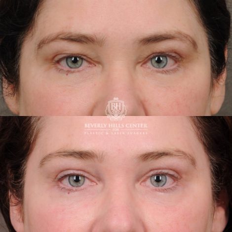 Beverly Hills Center Female Patient Before and After Upper Blepharoplasty