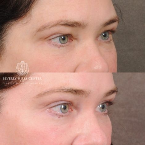 Beverly Hills Center Female Patient Before and After Upper Blepharoplasty