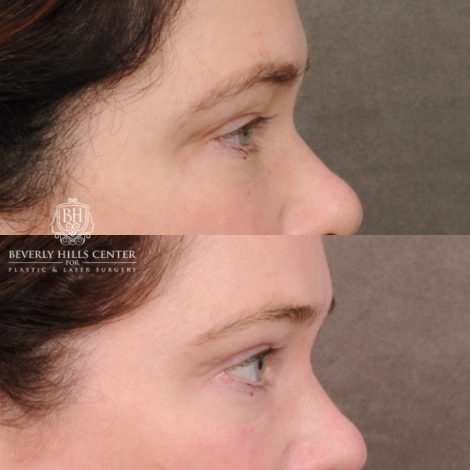 Beverly Hills Center Female Patient Before and After Upper Blepharoplasty