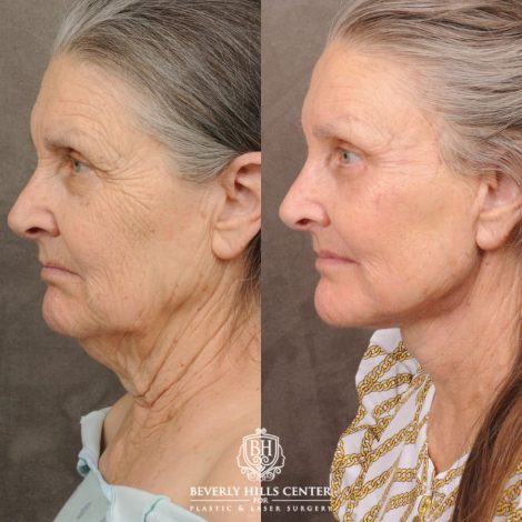 Beverly Hills Center Female Patient Before and After AuraLuft, Brow Lift, Upper Blepharoplasty, CUPID LIFT® Corner Lift, Fat Grafting & Ptosis Repair