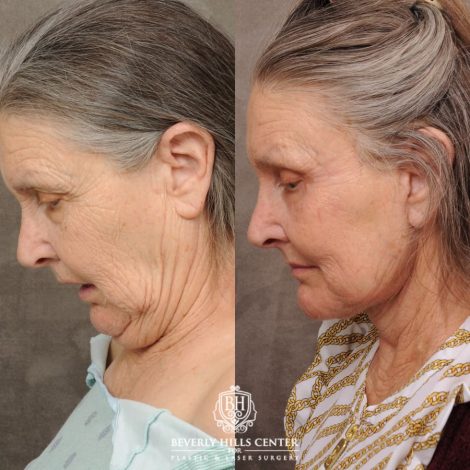 Beverly Hills Center Female Patient Before and After AuraLuft, Brow Lift, Upper Blepharoplasty, CUPID LIFT® Corner Lift, Fat Grafting & Ptosis Repair