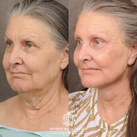 Beverly Hills Center Female Patient Before and After AuraLuft, Brow Lift, Upper Blepharoplasty, CUPID LIFT® Corner Lift, Fat Grafting & Ptosis Repair