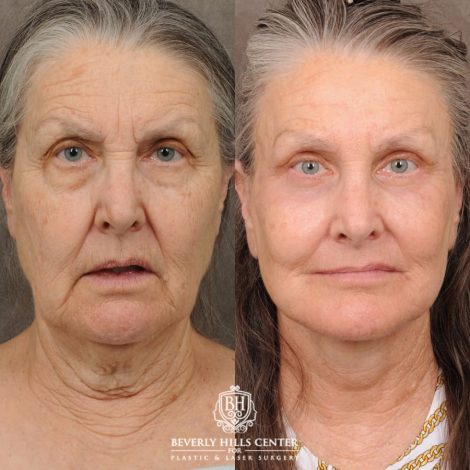 Beverly Hills Center Female Patient Before and After AuraLuft, Brow Lift, Upper Blepharoplasty, CUPID LIFT® Corner Lift, Fat Grafting & Ptosis Repair