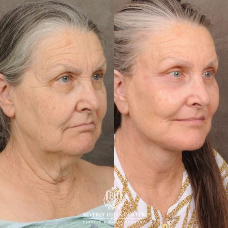 Beverly Hills Center Female Patient Before and After AuraLuft, Brow Lift, Upper Blepharoplasty, CUPID LIFT® Corner Lift, Fat Grafting & Ptosis Repair