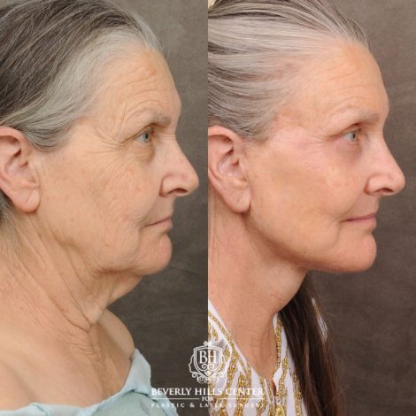 Beverly Hills Center Female Patient Before and After AuraLuft, Brow Lift, Upper Blepharoplasty, CUPID LIFT® Corner Lift, Fat Grafting & Ptosis Repair