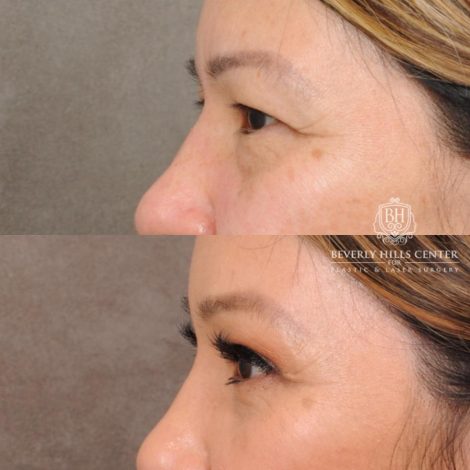 Beverly Hills Center Female Patient Before and After Upper Blepharoplasty