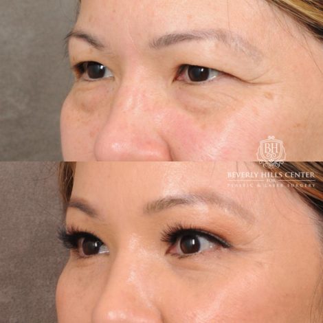 Beverly Hills Center Female Patient Before and After Upper Blepharoplasty