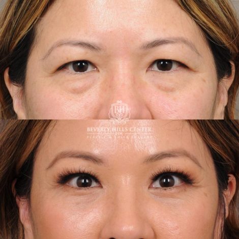 Beverly Hills Center Female Patient Before and After Upper Blepharoplasty