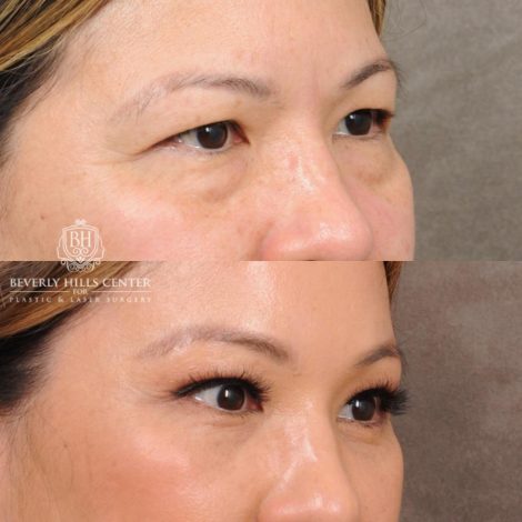 Beverly Hills Center Female Patient Before and After Upper Blepharoplasty