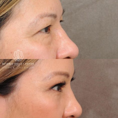 Beverly Hills Center Female Patient Before and After Upper Blepharoplasty