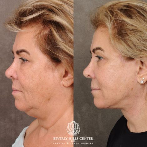 Beverly Hills Center Female Patient Before and After AuraLyft, CUPID LIFT® Corner Lift