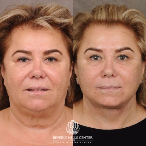 Beverly Hills Center Female Patient Before and After AuraLyft, CUPID LIFT® Corner Lift