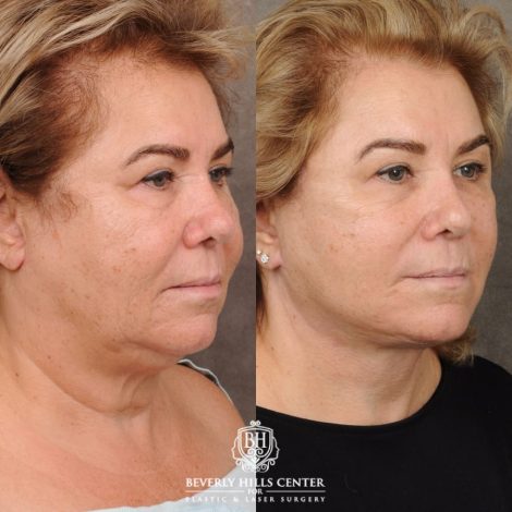 Beverly Hills Center Female Patient Before and After AuraLyft, CUPID LIFT® Corner Lift