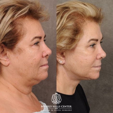 Beverly Hills Center Female Patient Before and After AuraLyft, CUPID LIFT® Corner Lift