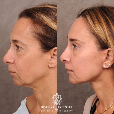 Beverly Hills Center Female Patient Before and After AuraLyft, Brow Lift, Upper & Lower Blepharoplasty, CUPID LIFT® Corner Lift