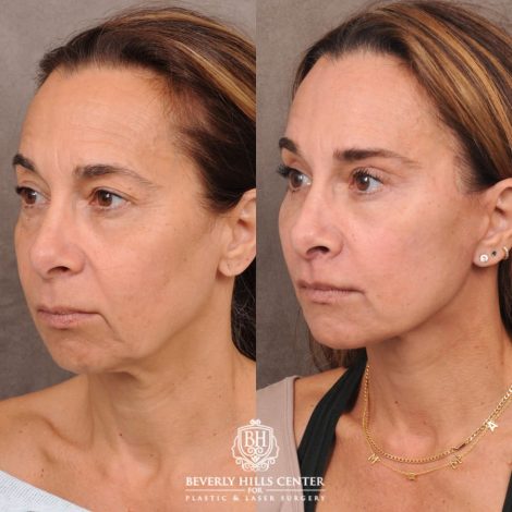 Beverly Hills Center Female Patient Before and After AuraLyft, Brow Lift, Upper & Lower Blepharoplasty, CUPID LIFT® Corner Lift