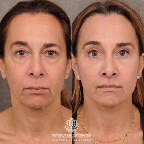 Beverly Hills Center Female Patient Before and After AuraLyft, Brow Lift, Upper & Lower Blepharoplasty, CUPID LIFT® Corner Lift