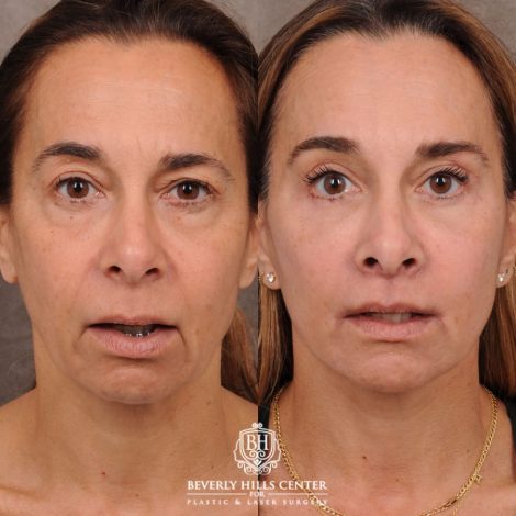 Beverly Hills Center Female Patient Before and After AuraLyft, Brow Lift, Upper & Lower Blepharoplasty, CUPID LIFT® Corner Lift