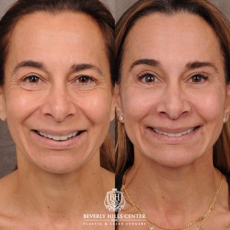 Beverly Hills Center Female Patient Before and After AuraLyft, Brow Lift, Upper & Lower Blepharoplasty, CUPID LIFT® Corner Lift