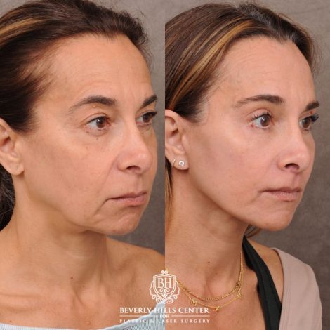 Beverly Hills Center Female Patient Before and After AuraLyft, Brow Lift, Upper & Lower Blepharoplasty, CUPID LIFT® Corner Lift