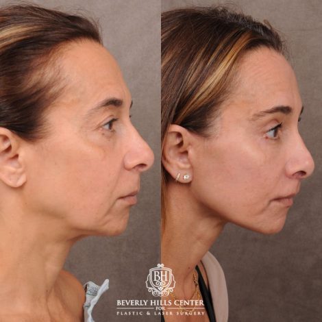 Beverly Hills Center Female Patient Before and After AuraLyft, Brow Lift, Upper & Lower Blepharoplasty, CUPID LIFT® Corner Lift
