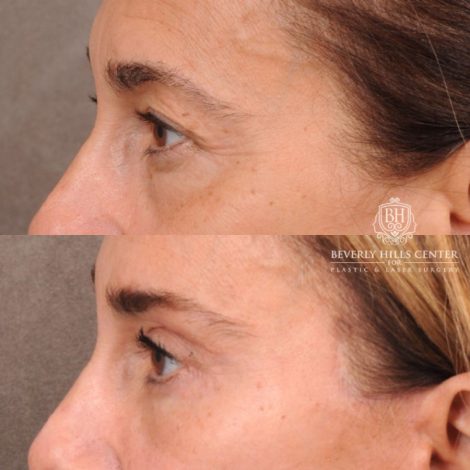 Beverly Hills Center Female Patient Before and After AuraLyft, Brow Lift, Upper & Lower Blepharoplasty, CUPID LIFT® Corner Lift