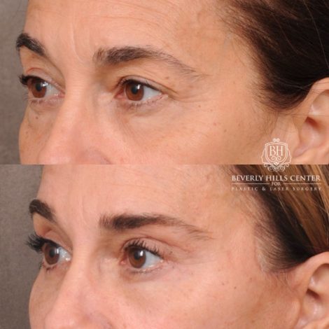 Beverly Hills Center Female Patient Before and After AuraLyft, Brow Lift, Upper & Lower Blepharoplasty, CUPID LIFT® Corner Lift