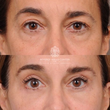 Beverly Hills Center Female Patient Before and After AuraLyft, Brow Lift, Upper & Lower Blepharoplasty, CUPID LIFT® Corner Lift