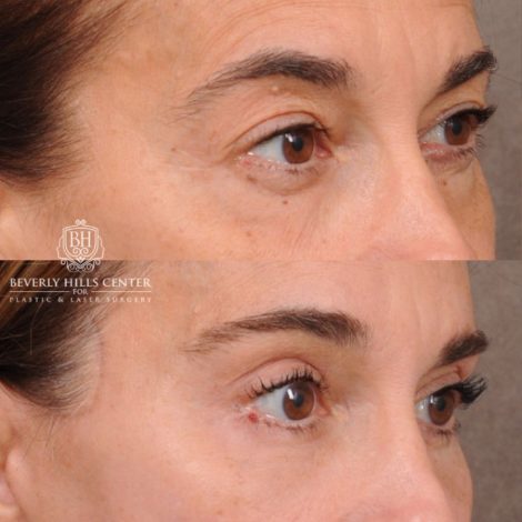Beverly Hills Center Female Patient Before and After AuraLyft, Brow Lift, Upper & Lower Blepharoplasty, CUPID LIFT® Corner Lift