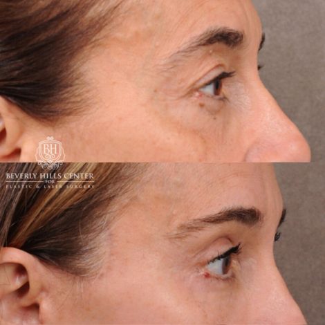 Beverly Hills Center Female Patient Before and After AuraLyft, Brow Lift, Upper & Lower Blepharoplasty, CUPID LIFT® Corner Lift