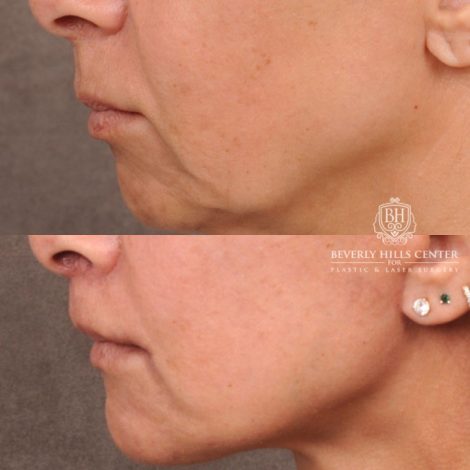 Beverly Hills Center Female Patient Before and After AuraLyft, Brow Lift, Upper & Lower Blepharoplasty, CUPID LIFT® Corner Lift