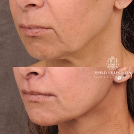 Beverly Hills Center Female Patient Before and After AuraLyft, Brow Lift, Upper & Lower Blepharoplasty, CUPID LIFT® Corner Lift