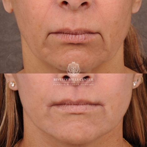 Beverly Hills Center Female Patient Before and After AuraLyft, Brow Lift, Upper & Lower Blepharoplasty, CUPID LIFT® Corner Lift