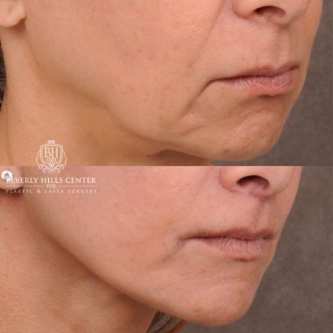 Beverly Hills Center Female Patient Before and After AuraLyft, Brow Lift, Upper & Lower Blepharoplasty, CUPID LIFT® Corner Lift