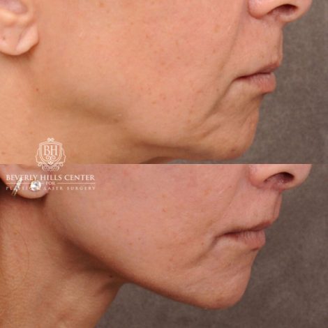 Beverly Hills Center Female Patient Before and After AuraLyft, Brow Lift, Upper & Lower Blepharoplasty, CUPID LIFT® Corner Lift