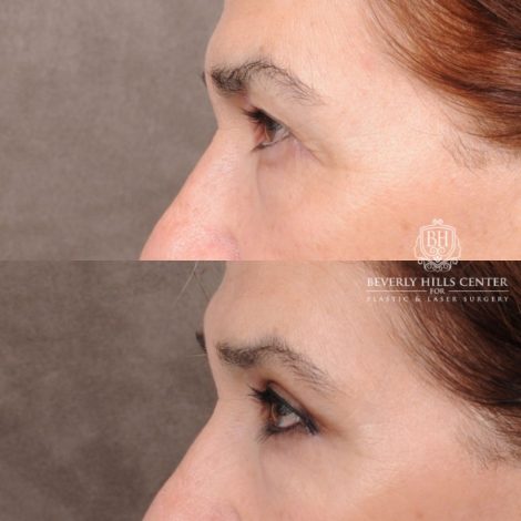 Beverly Hills Center Female Patient Before and After Upper Blepharoplasty