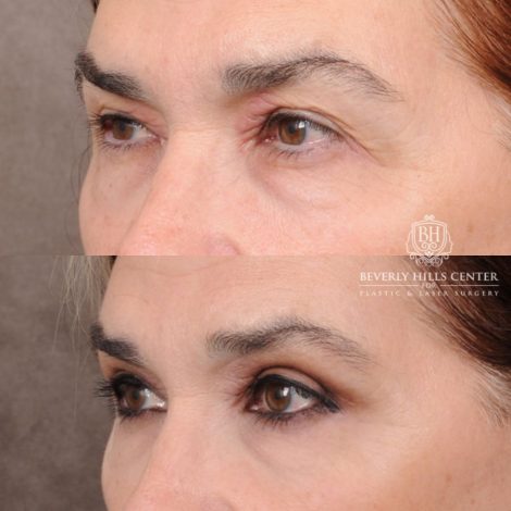 Beverly Hills Center Female Patient Before and After Upper Blepharoplasty