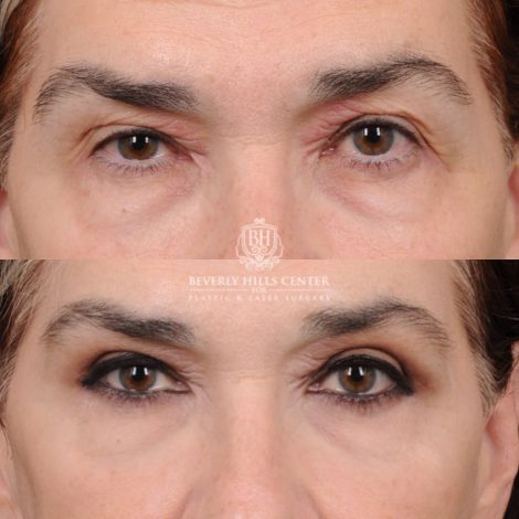 Beverly Hills Center Female Patient Before and After Upper Blepharoplasty