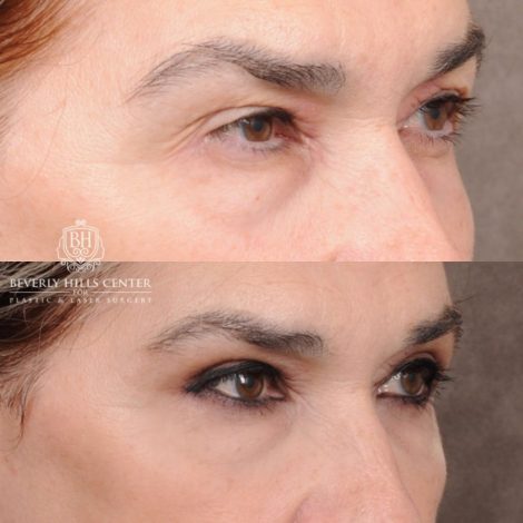 Beverly Hills Center Female Patient Before and After Upper Blepharoplasty