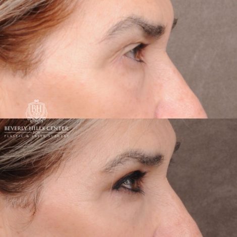 Beverly Hills Center Female Patient Before and After Upper Blepharoplasty