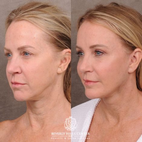 Beverly Hills Center Female Patient Before and After AuraLyft, Brow Lift, Upper Blepharoplasty